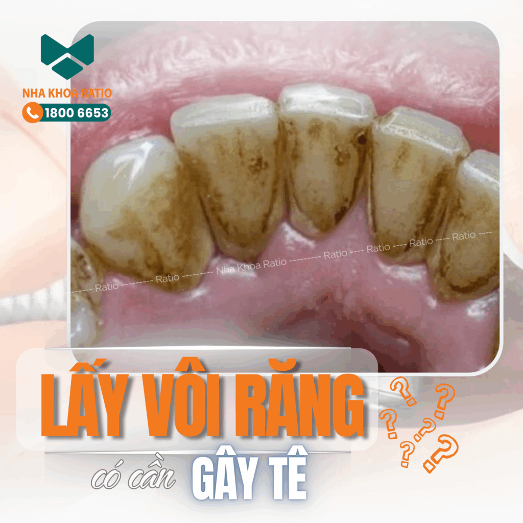 Lấy vôi răng Nha Khoa Ratio