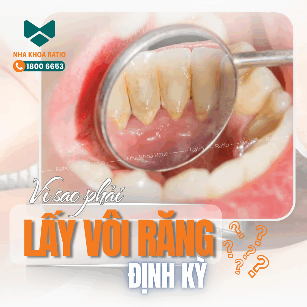 Lấy vôi răng Nha Khoa Ratio