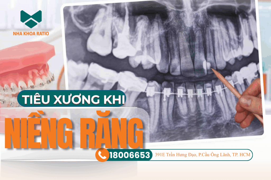 tiêu xương khi niềng răng nha khoa Ratio