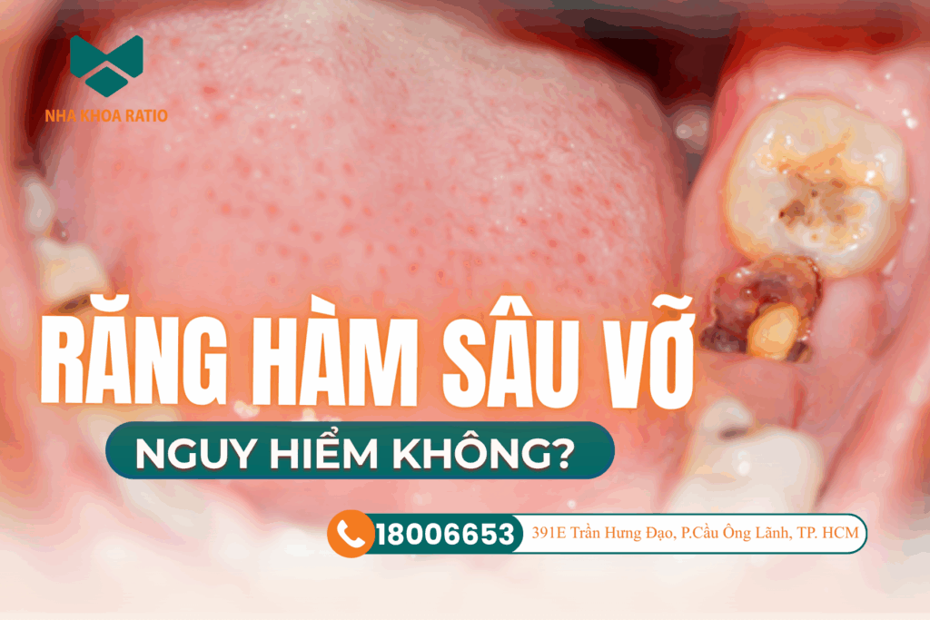 Răng hàm sâu vỡ nha khoa Ratio