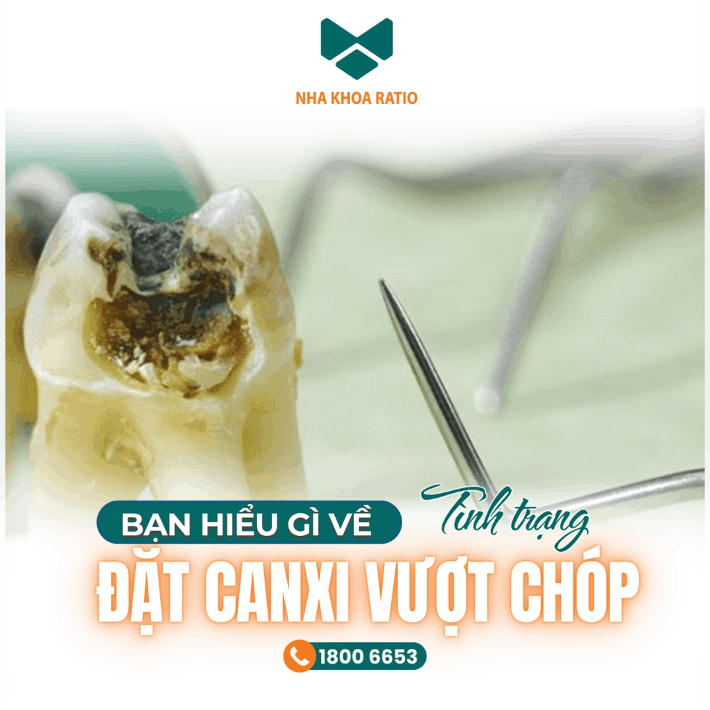 Đặt canxi vượt chóp nha khoa Ratio