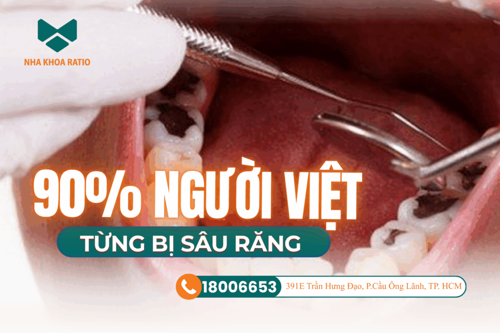 Sâu răng nha khoa Ratio