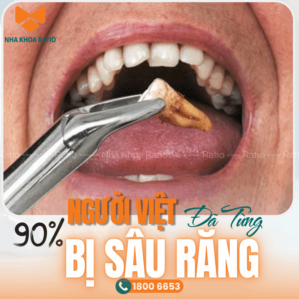 Sâu răng nha khoa Ratio