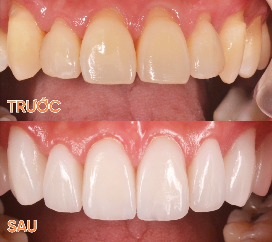 ảnh trước sau dán sứ veneer