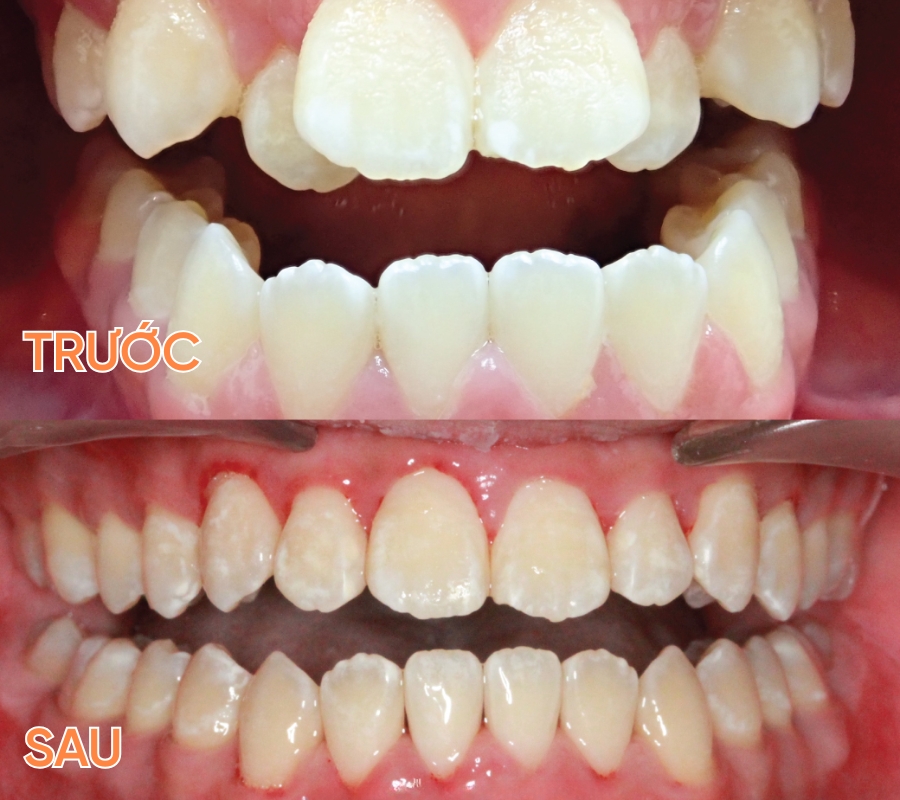 ảnh trước sau niềng răng trong suốt