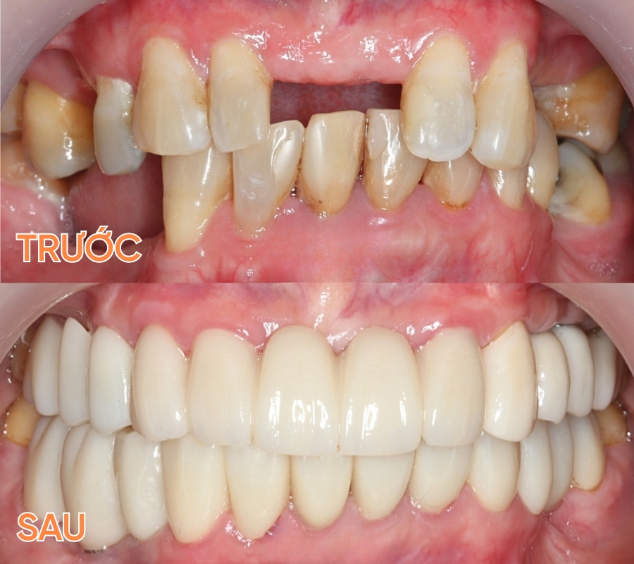ảnh trước sau trồng răng implant và chỉnh nha