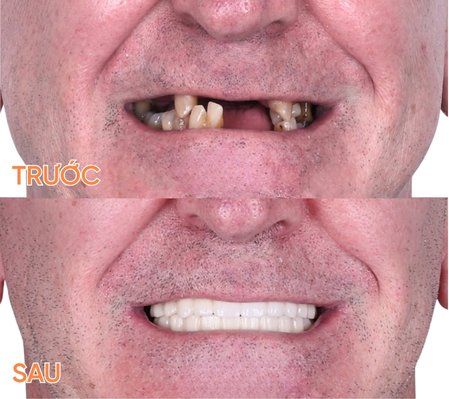 ảnh trước sau trồng răng implant