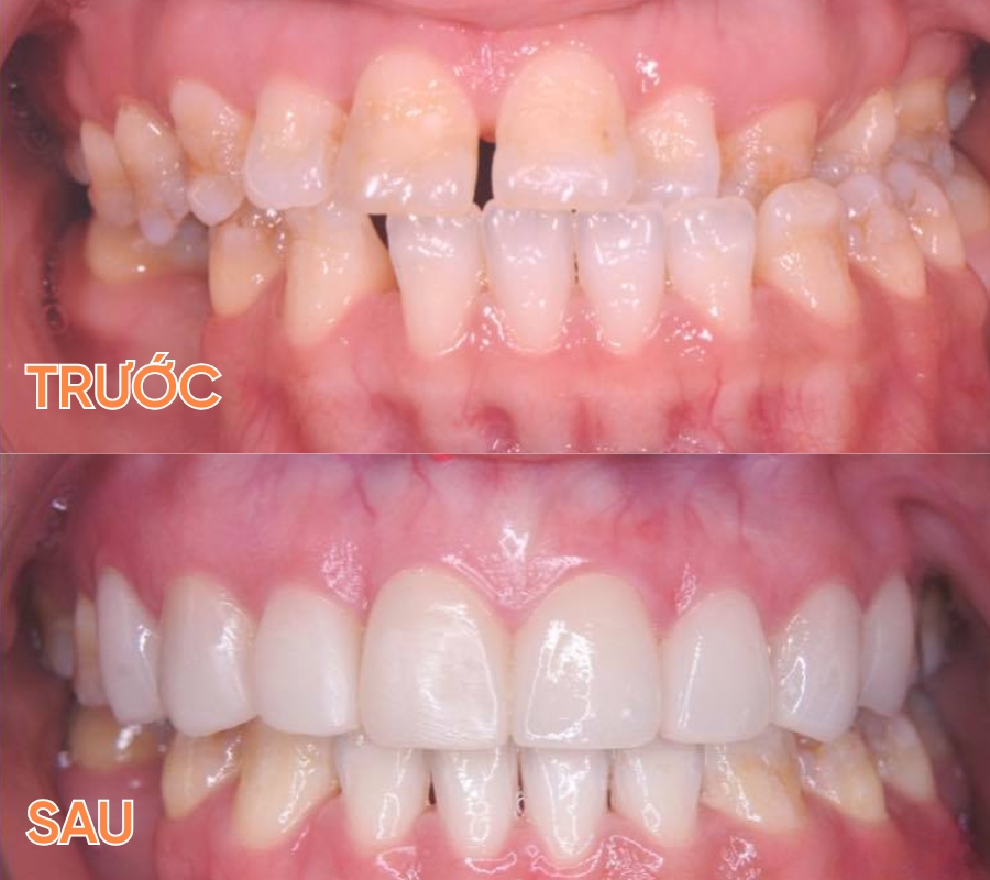 ảnh trước và sau khi niềng răng trong suốt
