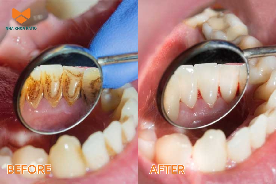 Tẩy cao răng là phương pháp loại bỏ lớp mảng bám cứng bám trên răng và dưới nướu.