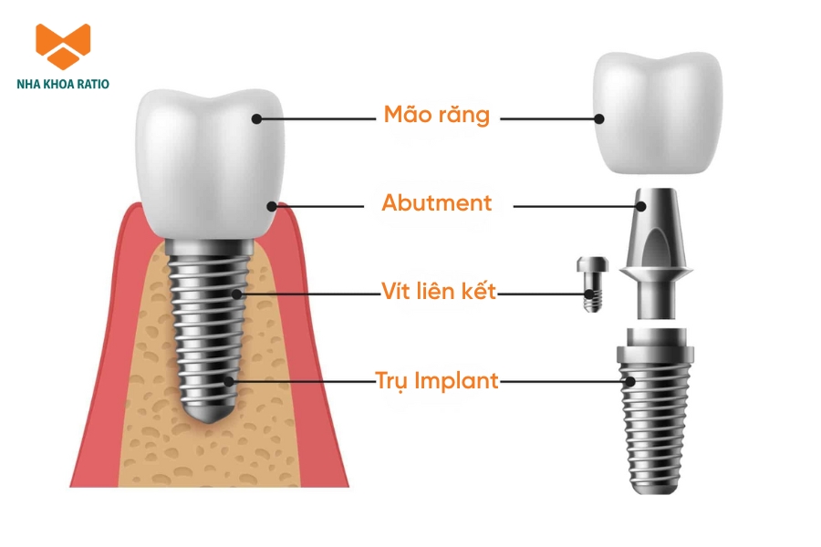 Răng Implant gồm trụ Implant, khớp nối Abutment và mão sứ, phối hợp với nhau để thay thế một chiếc răng thật hoàn chỉnh. Răng Implant gồm trụ Implant, khớp nối Abutment và mão sứ, phối hợp với nhau để thay thế một chiếc răng thật hoàn chỉnh.