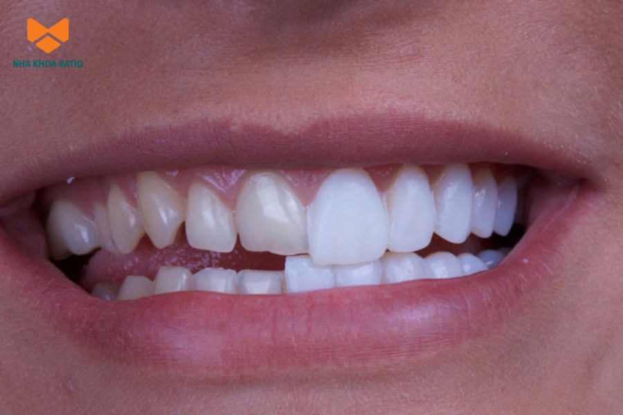 Dán sứ Veneer gắn một lớp sứ mỏng lên mặt răng để cải thiện màu sắc và hình dáng mà không cần mài nhiều răng Dán sứ Veneer gắn một lớp sứ mỏng lên mặt răng để cải thiện màu sắc và hình dáng mà không cần mài nhiều răng