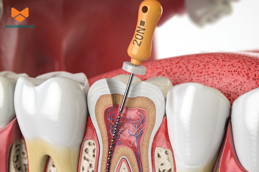 Chữa tủy là thủ thuật loại bỏ mô tủy viêm, làm sạch và trám bít ống tủy để bảo tồn răng thật và ngăn nhiễm trùng lan rộng.