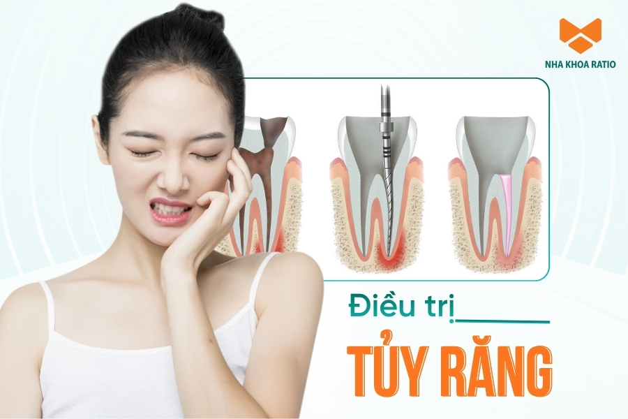 Điều trị tủy răng là gì? Chi phí và quy trình chữa tủy như thế nào?
