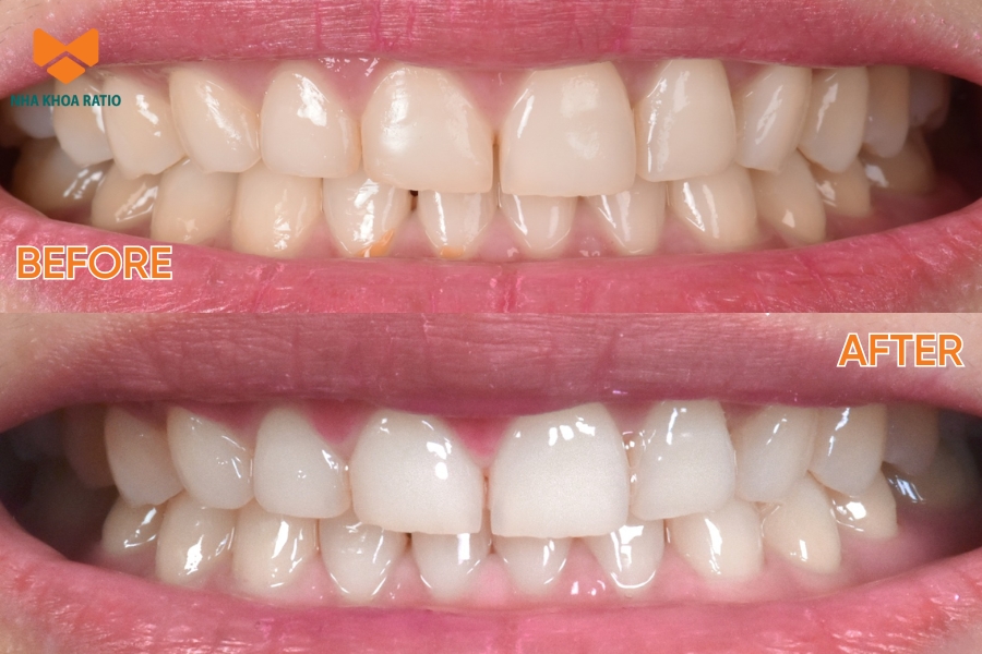 Răng bật 2- 3 tone sau 1 buổi tẩy trắng răng tại nha khoa Ratio