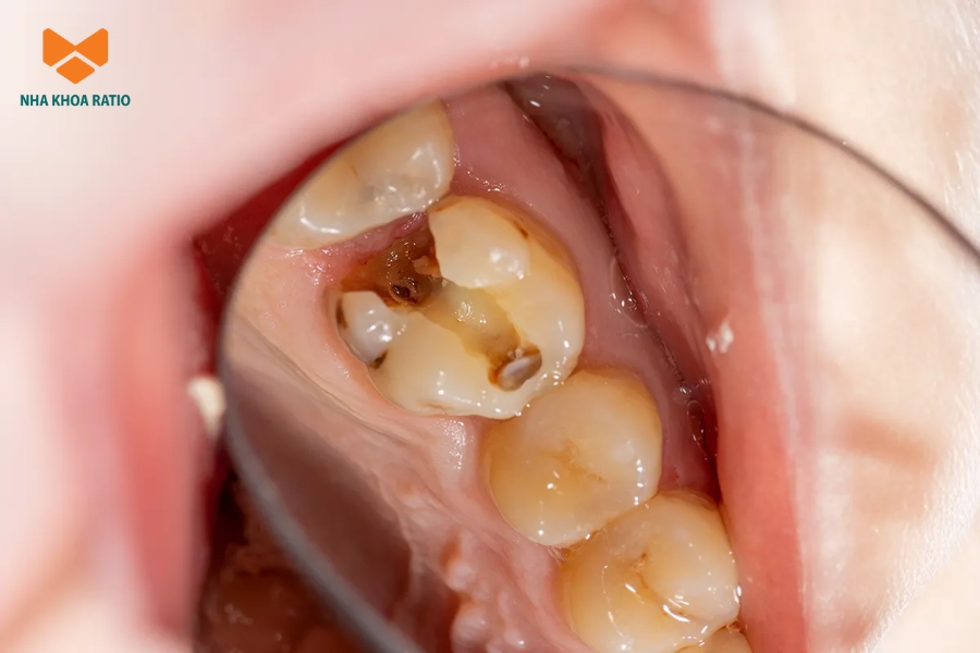 Bạn cần điều trị tủy răng khi sâu răng lan rộng vào đến tủy, gây đau kéo dài