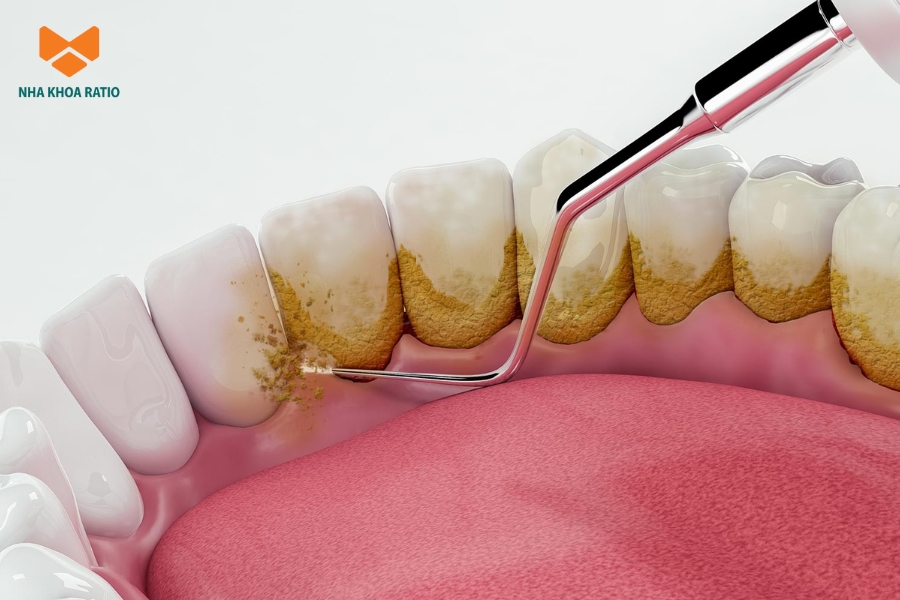 Lấy vôi răng giúp loại bỏ vết ố từ cao răng, khiến răng trông sáng và sạch hơn.