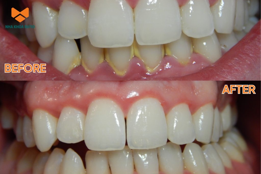Cạo vôi răng giúp giảm vi khuẩn tích tụ, từ đó ngăn ngừa viêm nướu, sâu răng