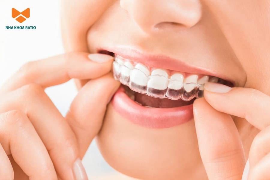 Bạn nên tuân thủ các chỉ định của bác sĩ để quá trình niềng răng Invisalign đạt hiệu quả tốt hơn Bạn nên tuân thủ các chỉ định của bác sĩ để quá trình niềng răng Invisalign đạt hiệu quả tốt hơn
