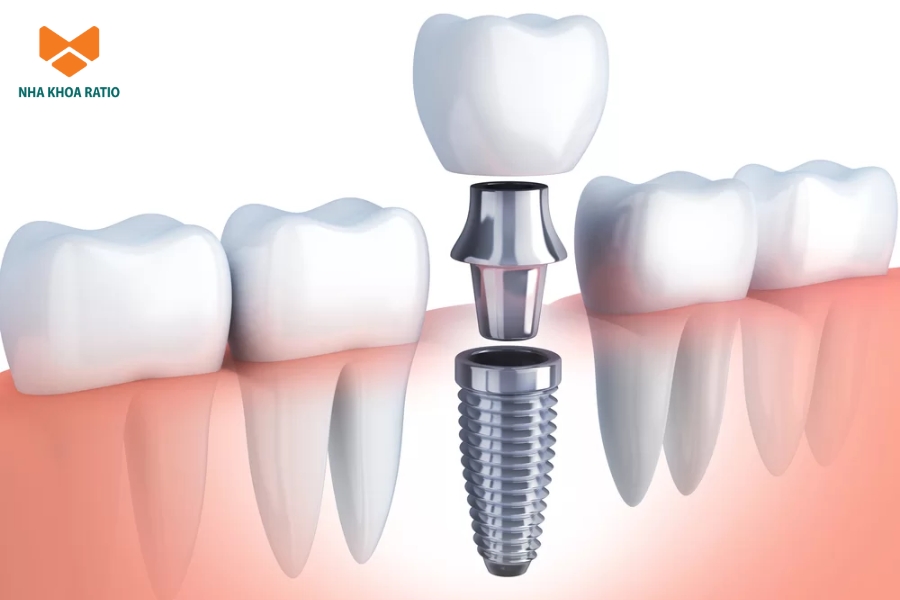 Cô chú bị mất một răng, nhiều răng hoặc mất răng lâu năm dẫn đến tiêu xương nên trồng răng Implant Cô chú bị mất một răng, nhiều răng hoặc mất răng lâu năm dẫn đến tiêu xương nên trồng răng Implant