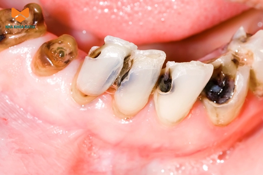 Những người bị sâu răng, răng hư tổn hoặc nứt mẻ dài lâu nên làm răng sứ để bảo vệ phần răng còn lại Những người bị sâu răng, răng hư tổn hoặc nứt mẻ dài lâu nên làm răng sứ để bảo vệ phần răng còn lại