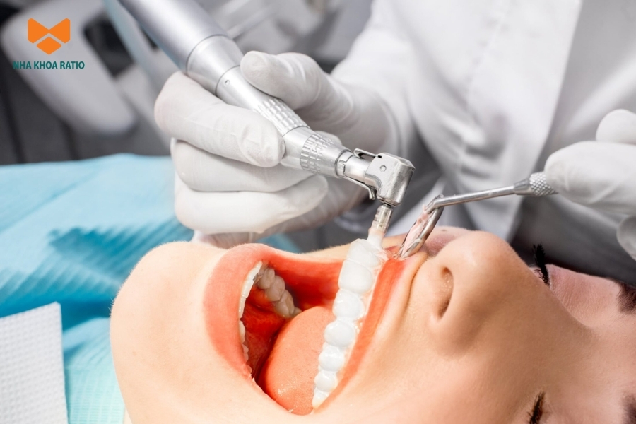 Quy trình cạo vôi răng chuẩn Y Khoa tại nha khoa Ratio