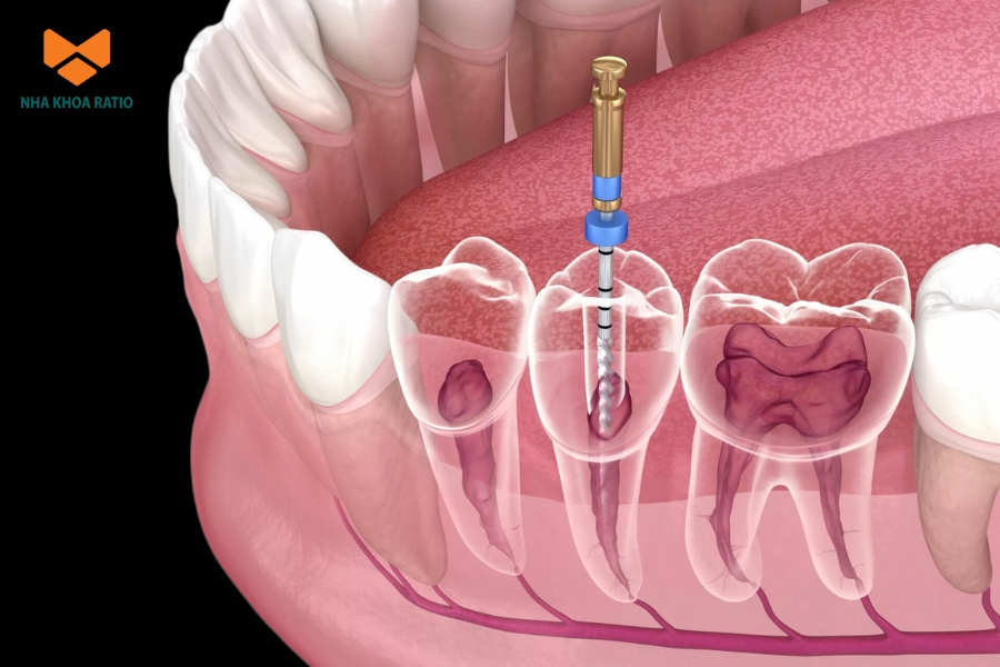 Quy trình lấy tủy răng cần được thực hiện trong môi trường vô trùng, đảm bảo chuẩn Y Khoa
