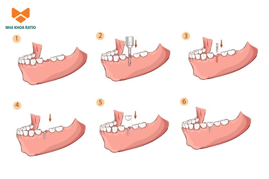 Quy trình trồng răng Implant chuẩn Y Khoa tại nha khoa Ratio Quy trình trồng răng Implant chuẩn Y Khoa tại nha khoa Ratio