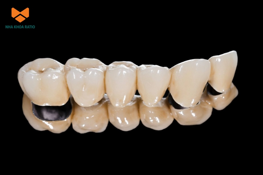 Răng sứ là mão răng được chế tác từ vật liệu sứ để bao phủ răng thật Răng sứ là mão răng được chế tác từ vật liệu sứ để bao phủ răng thật