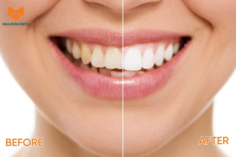 Tẩy trắng răng dùng hoạt chất oxy hóa để làm sáng màu răng mà không ảnh hưởng đến men răng