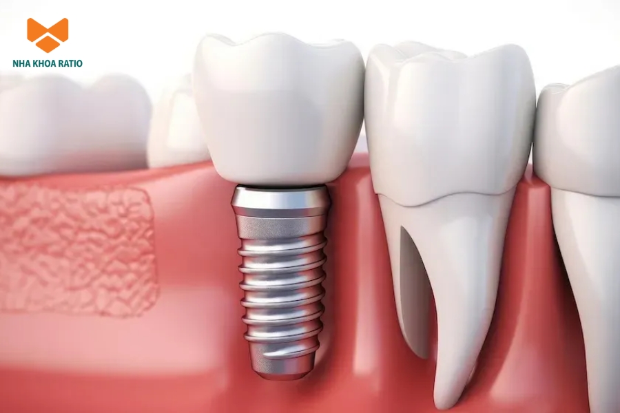 Trồng Implant một răng giúp thay thế răng đã mất bằng một trụ Implant và mão sứ riêng lẻ a dental implant in a gum model