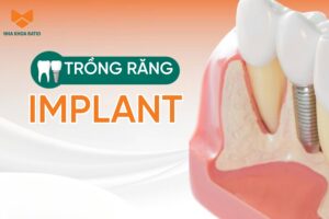 Trồng răng Implant - Giải pháp phục hồi chức năng ăn nhai như răng thật