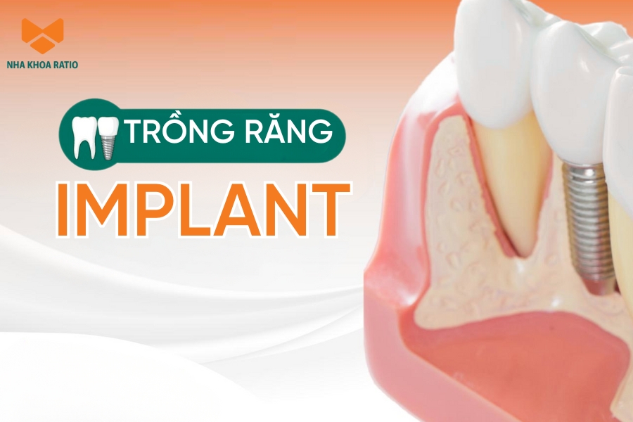 Trồng răng Implant - Giải pháp phục hồi chức năng ăn nhai như răng thật
