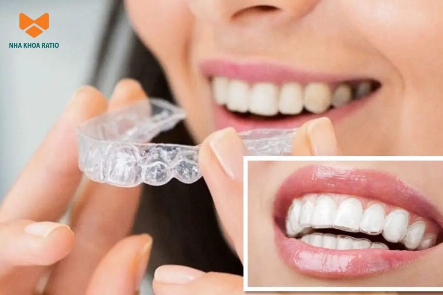 Khay trong suốt ôm sát răng, giúp bạn chỉnh nha kín đáo, mang tính thẩm mỹ cao Khay trong suốt ôm sát răng, giúp bạn chỉnh nha kín đáo, mang tính thẩm mỹ cao