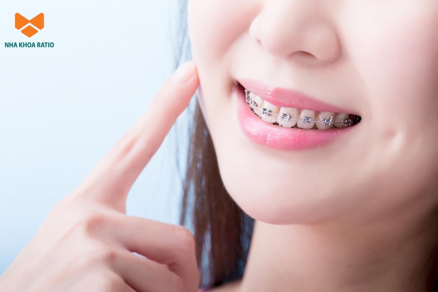 Niềng răng có bị hóp má không? Phương pháp này không trực tiếp gây hóp má