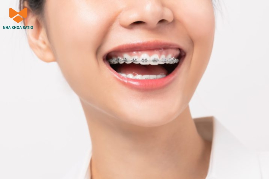 Má hóp trong quá trình niềng răng không ảnh hưởng sức khỏe nhưng gây mất thẩm mỹ