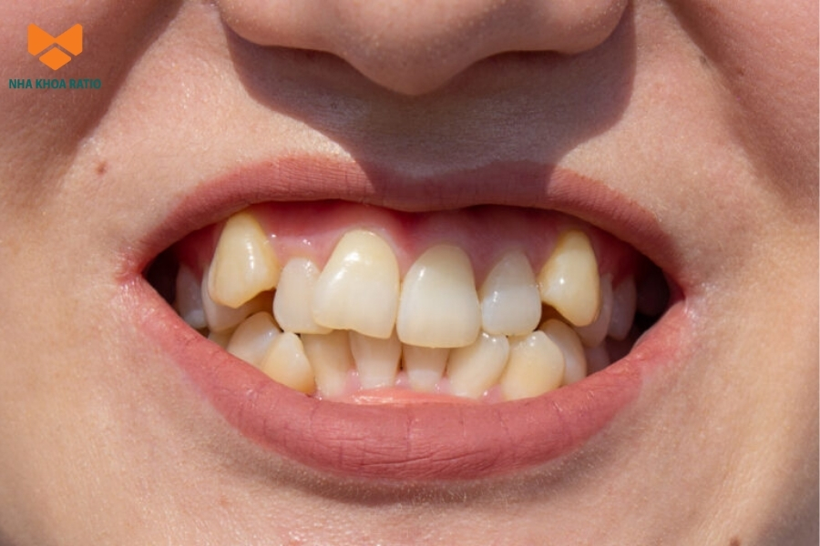 Niềng răng trong suốt được chỉ định nhổ răng khi răng mọc lệch quá nhiều