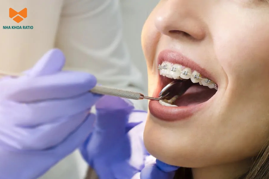 Bác sĩ thực hiện không đúng kỹ thuật làm răng dịch chuyển sai hướng