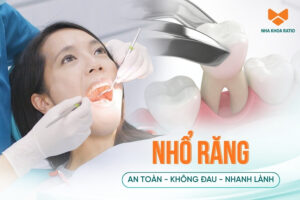 Nhổ răng: Đối tượng chỉ định, quy trình và một số lưu ý