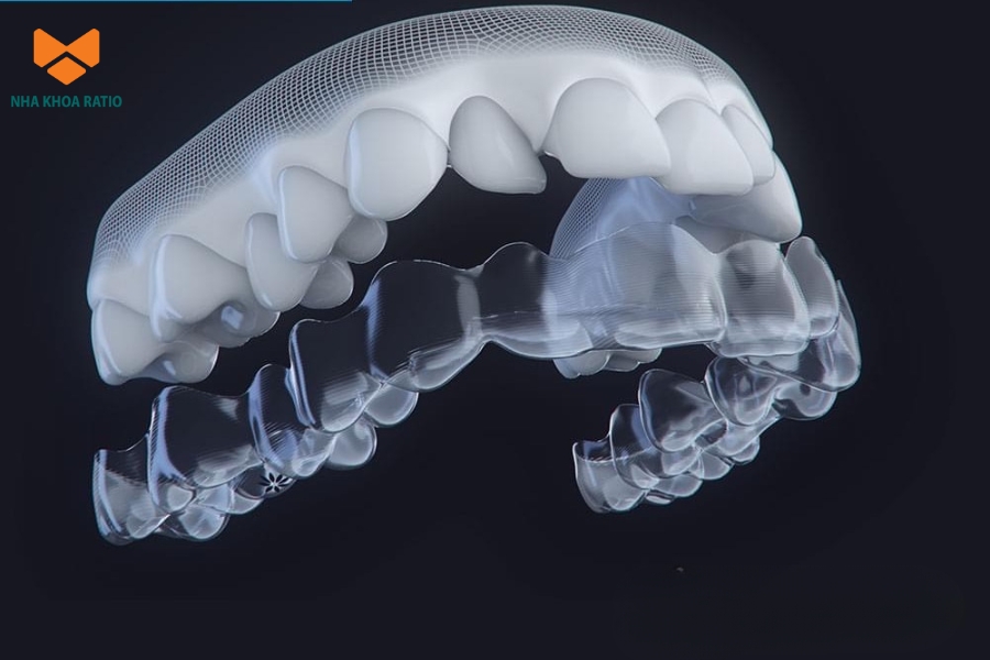 Khay kém chất lượng có thể làm chậm tiến trình hoặc khiến phác đồ phải điều chỉnh lại. Khay kém chất lượng có thể làm chậm tiến trình hoặc khiến phác đồ phải điều chỉnh lại.