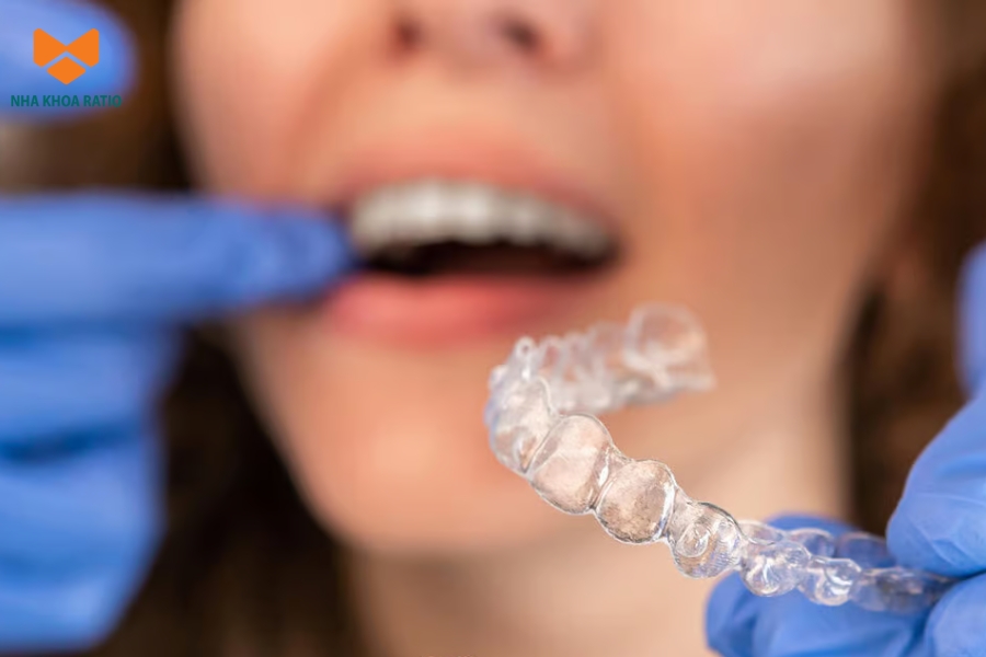 Tay nghề bác sĩ ảnh hưởng lớn đến niềng răng trong suốt mất bao lâu Tay nghề bác sĩ ảnh hưởng lớn đến niềng răng trong suốt mất bao lâu