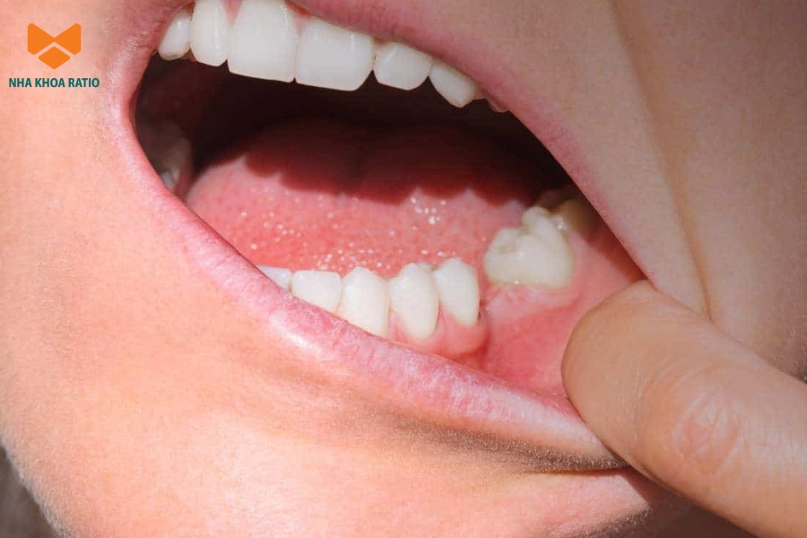 Mất răng lâu ngày khiến xương ổ răng bị tiêu, làm giảm nâng đỡ vùng má và tạo cảm giác hóp khi niềng răng.