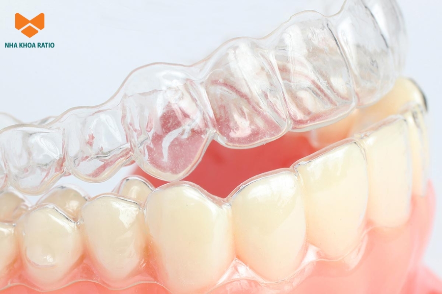 Niềng răng trong suốt mất bao lâu? Khoảng 1 - 5 năm tùy trường hợp Niềng răng trong suốt mất bao lâu? Khoảng 1 - 5 năm tùy trường hợp