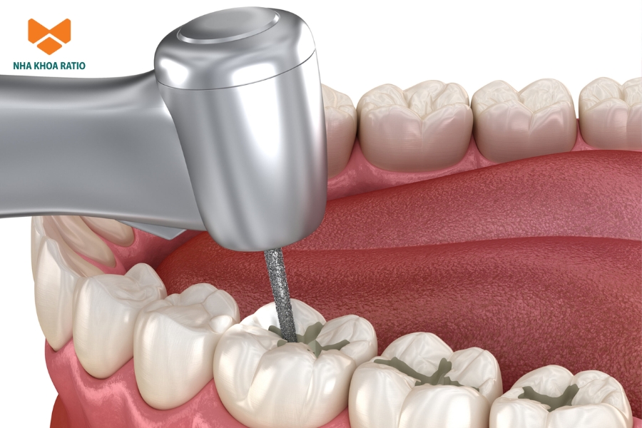 Trám răng giúp phục hồi phần răng bị hư tổn, bảo vệ răng thật