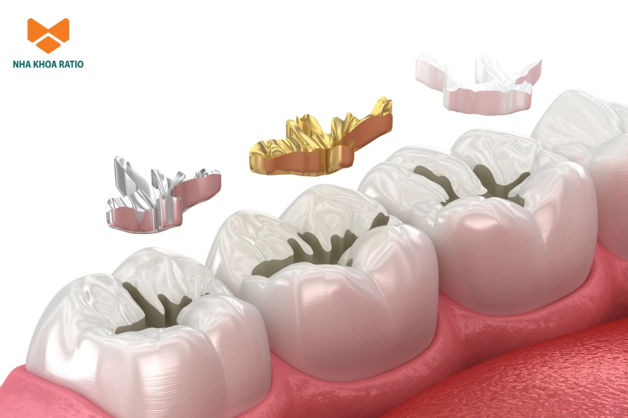 Trám răng sử dụng vật liệu nha khoa để lấp đầy phần răng bị sâu hoặc sứt mẻ