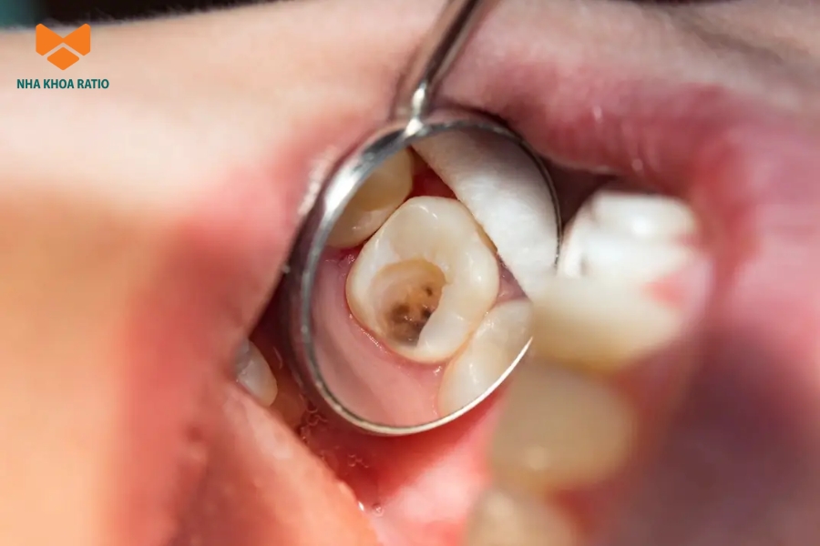 Trám răng sâu giúp ngăn sâu lan rộng, giảm nguy cơ mất răng.