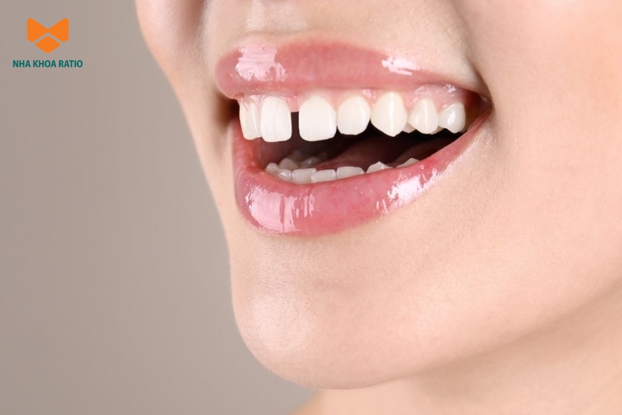 Trám răng thưa giúp lấp đầy khoảng hở, cải thiện thẩm mỹ và hỗ trợ răng ăn nhai ổn định hơn